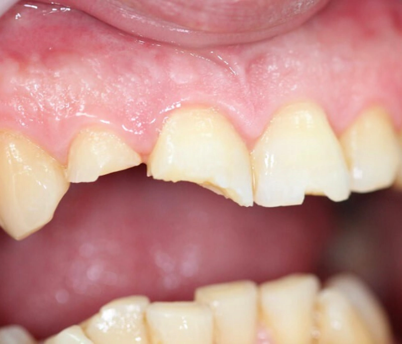 Răng vỡ lớn sẽ ảnh hưởng thẩm mỹ, gây ê buốt, khó khăn khi ăn nhai